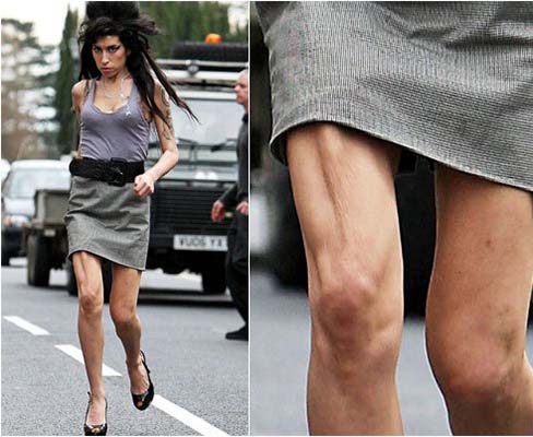 amy-winehouse-boney-leg